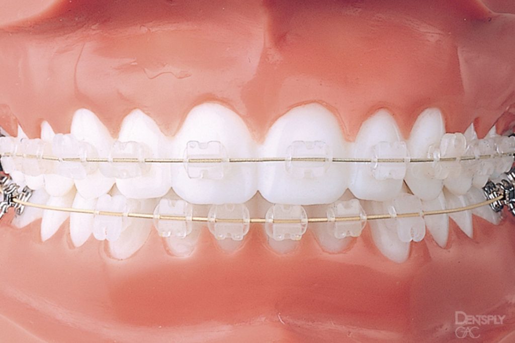 orthodontiki-therapeia-enilikon